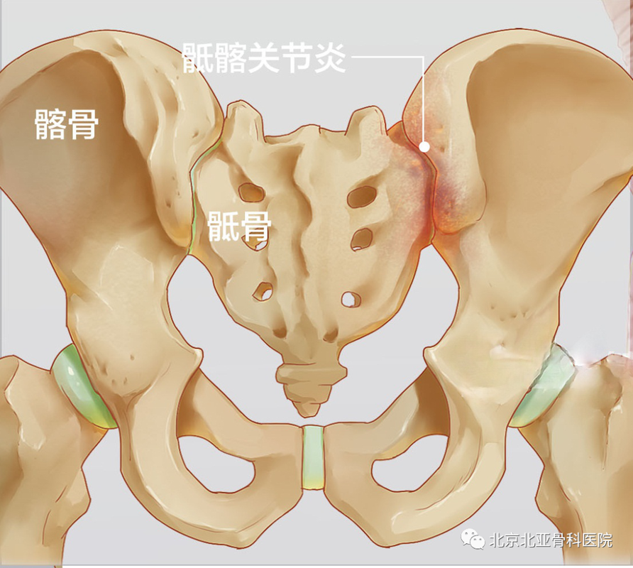 髂-女性為什么得了骶髂關(guān)節(jié)炎